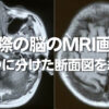 MRI断面図